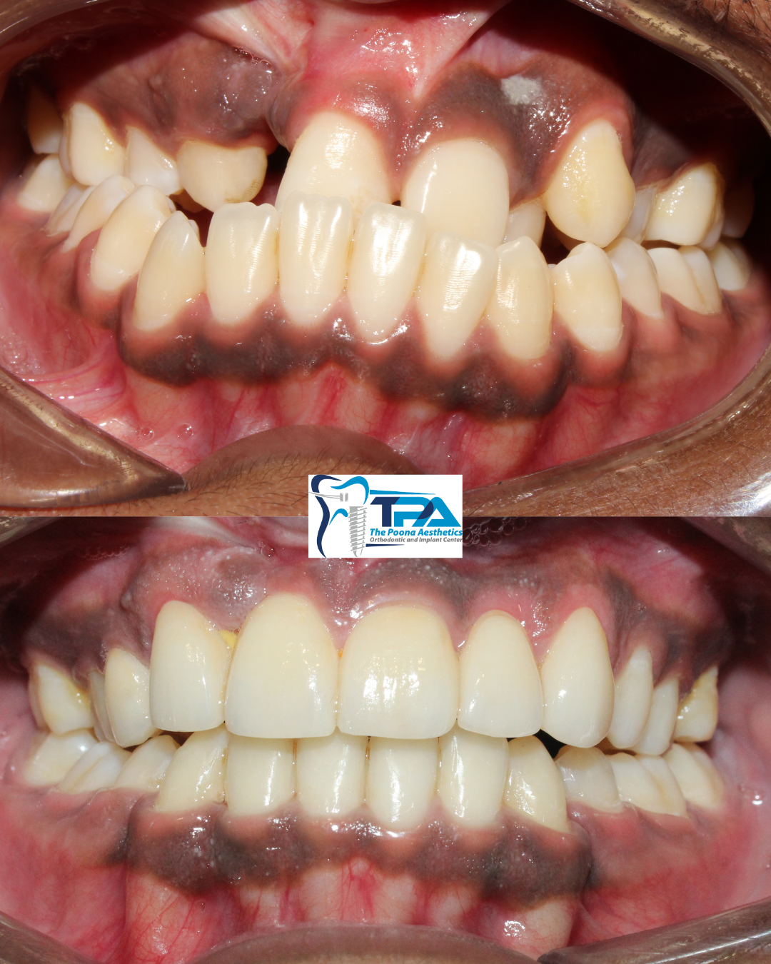 Before/After