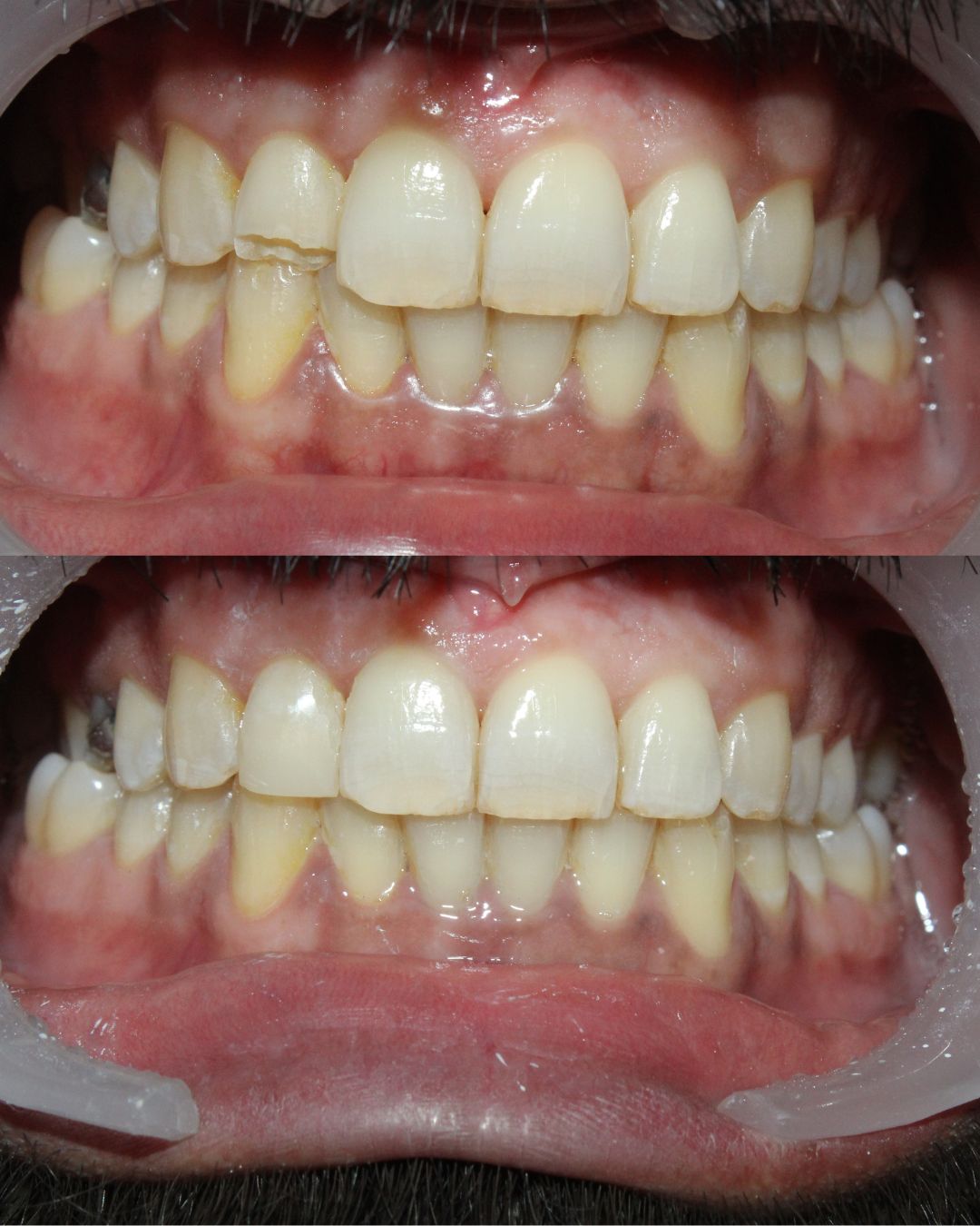 Before/After