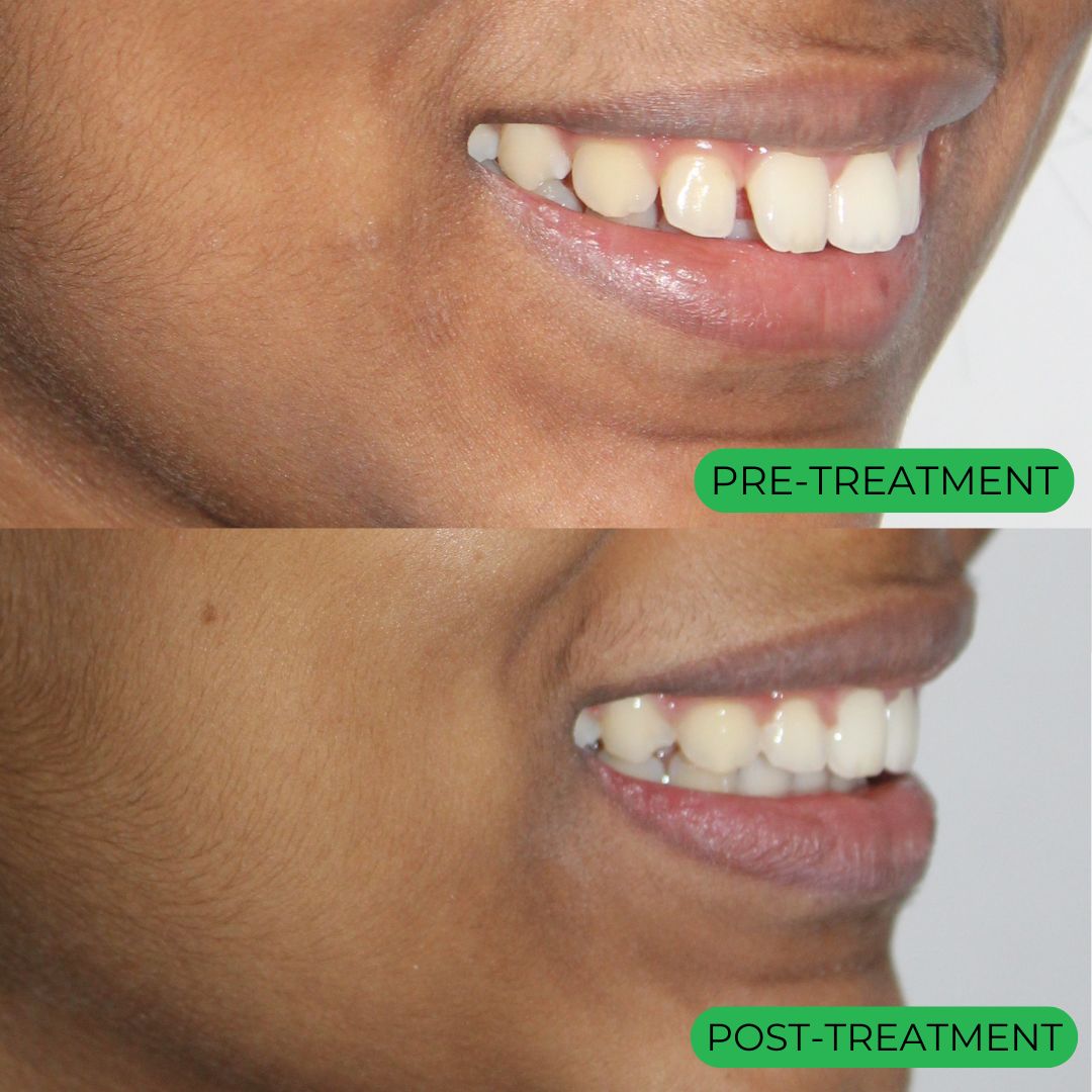 Before/After