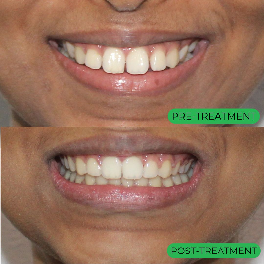 Before/After